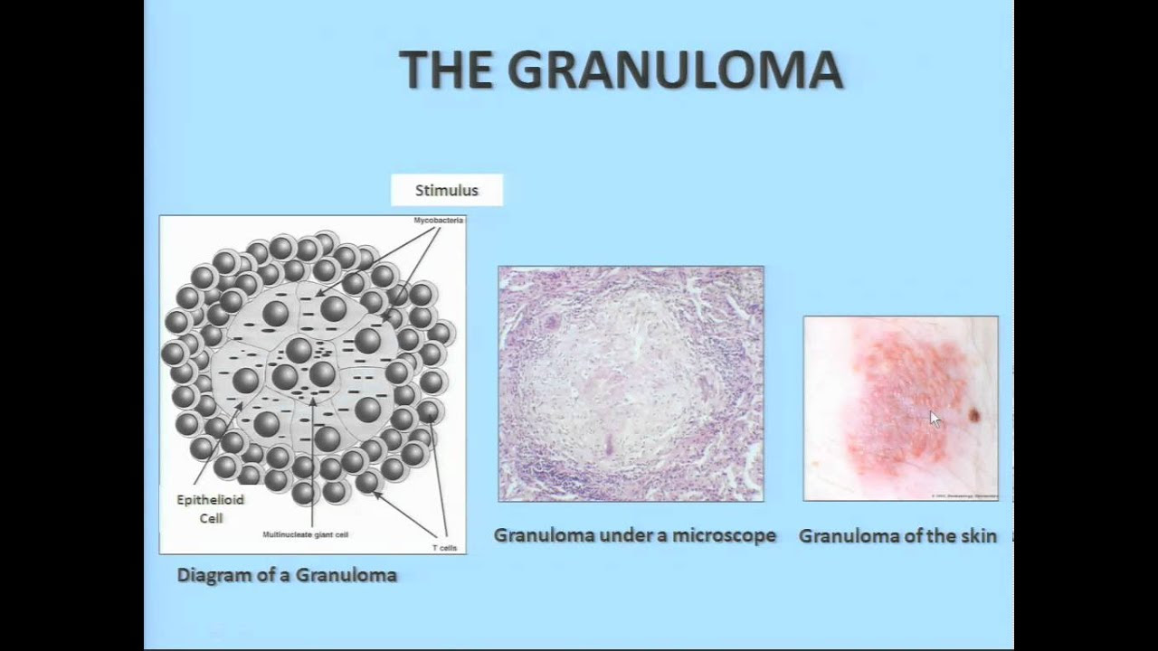What is Sarcoidosis? - Adam Morgenthau, MD, Mt. Sinai Medical Center - YouTube