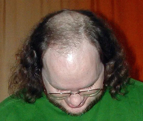 Barber Advice On Male Pattern Baldness - Sharpologist