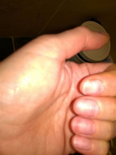 remedies  nail pain  removing acrylic nails