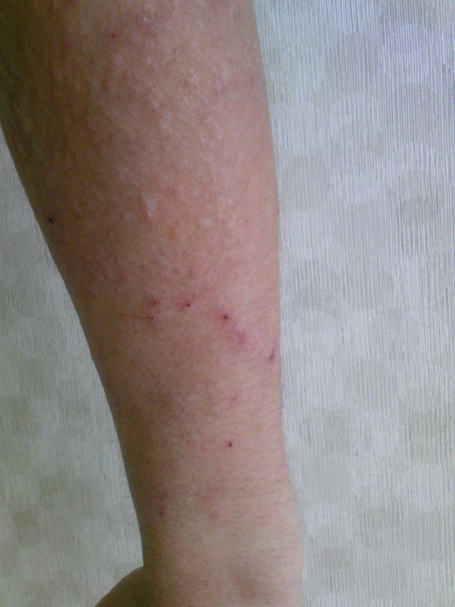 アトピー 私はこれが効きました 情報交換 コテ禁止スレ 無断転載禁止 C 2