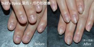 Nail S Spica 広島市中区中町のネイルサロン 自爪の形がキレイに生え変わる施術 深爪矯正 深爪改善 巻き爪改善 フルオーダメイドのデザインネイル キャラネイル 痛ネイル ブライダルネイル 大人ネイル ペット同伴可