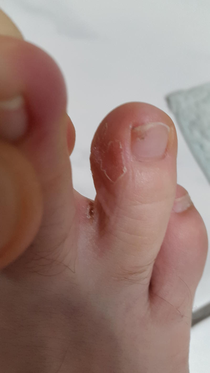 Haut Zwischen Zehen Sprode Rissig Dermatologie Med1