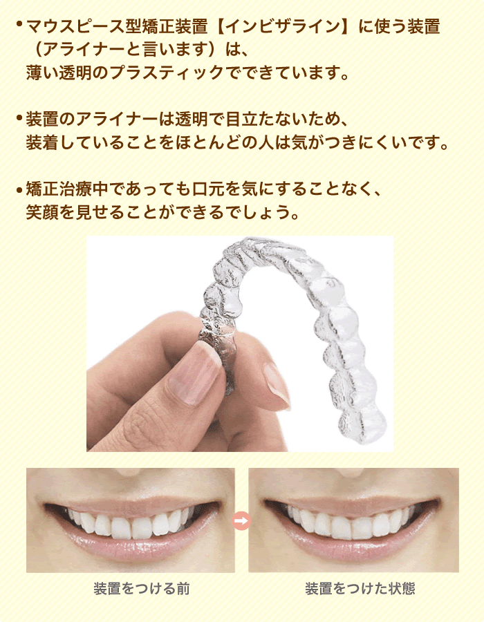 マウスピース型矯正装置 インビザライン