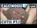 Hair Bumps On Balls