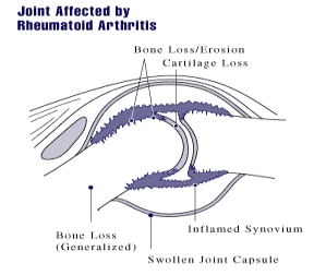Arthritis Pain in Knee: Symptoms, Diagnosis & Treatment