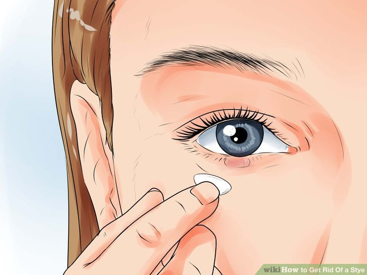 Get Rid of a Stye Step 10 Version 3.jpg