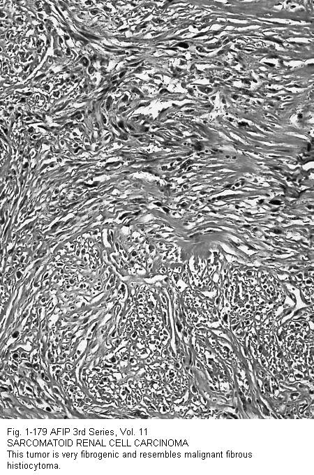colon cancer vs ibs
