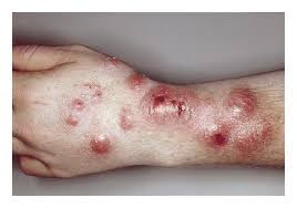 Les Dermatoses Estivales