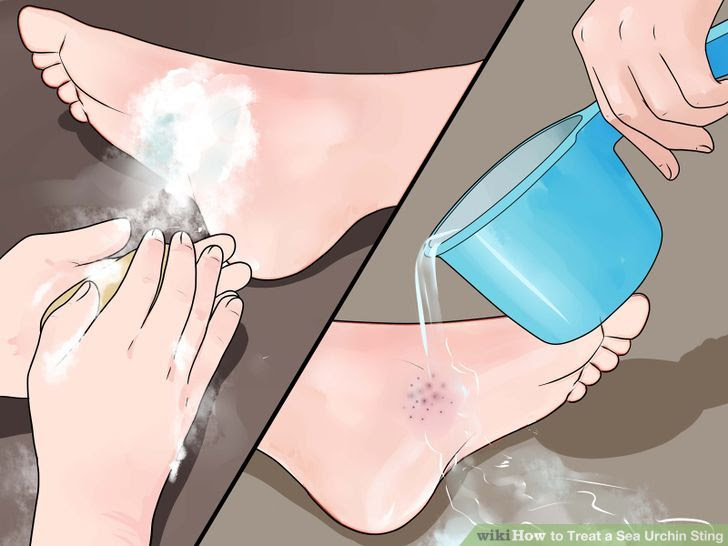 Treat a Sea Urchin Sting Step 5 Version 2.jpg