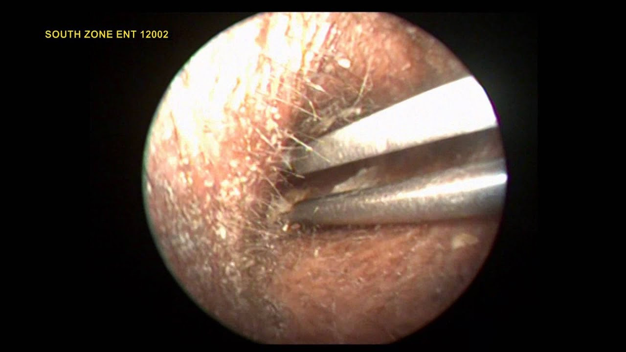 EAR WAX REMOVAL USING FORCEPS - YouTube