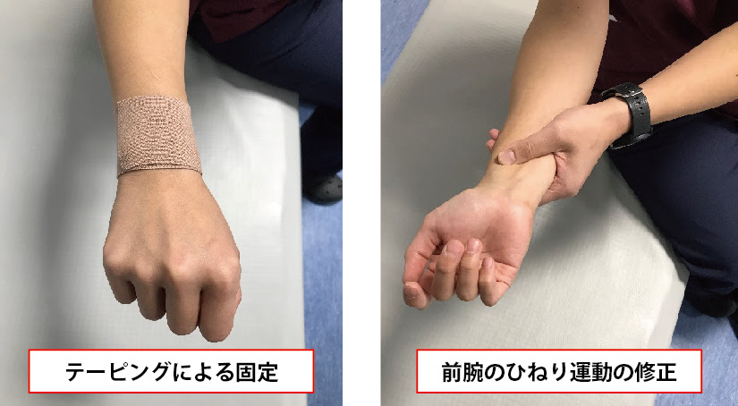 Tfcc損傷 ぜんしん整形外科 立川スポーツリハビリクリニック