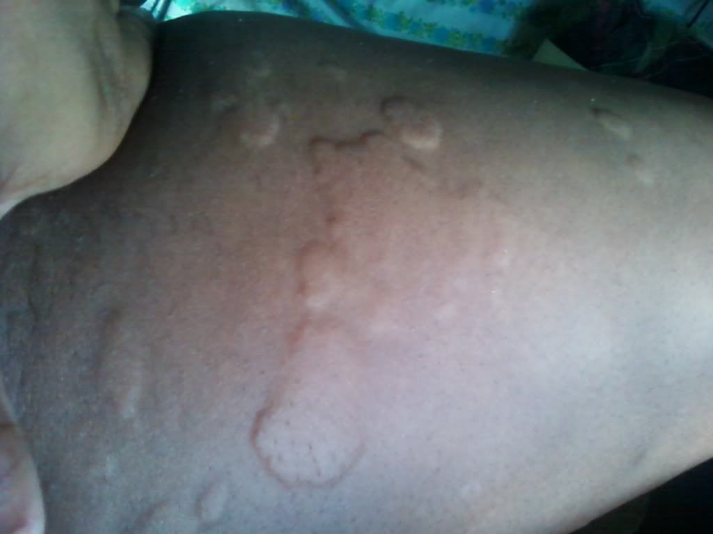 Viewing Gallery For - Bed Bug Bites On African Americans