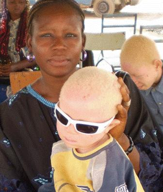 Image result for albinos in nigeria