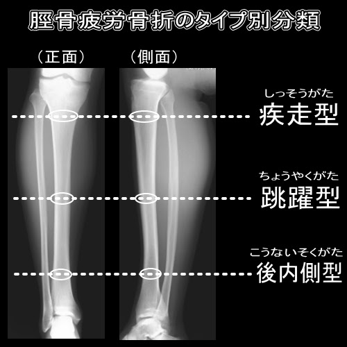 すねの痛み 脛骨疲労骨折 よくある症状 疾患 札幌スポーツクリニック 札幌市中央区の整形外科 内科 リハビリ科