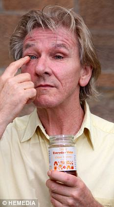 Frank suffered blepharitis that caused chronic inflammation of the eyelid