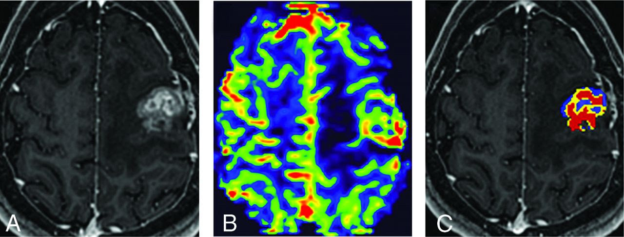 Dsc Perfusion Mri Derived Fractional Tumor Burden And Relative Cbv Differentiate Tumor Progression And Radiation Necrosis In Brain Metastases Treated With Stereotactic Radiosurgery American Journal Of Neuroradiology