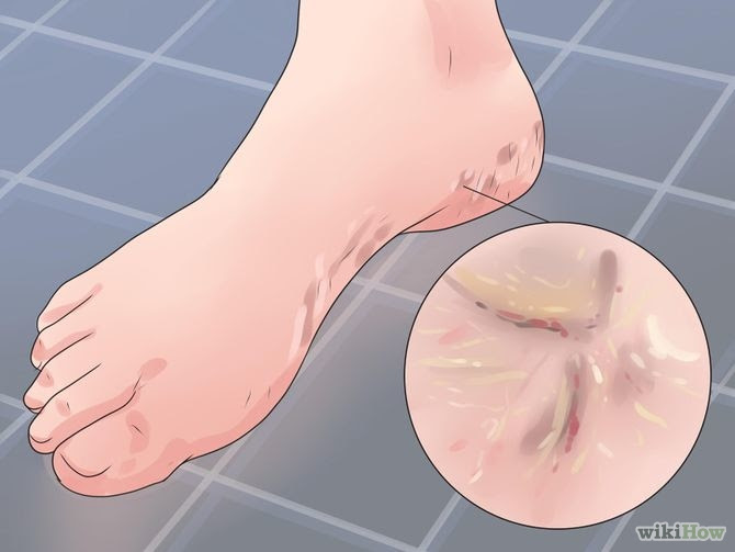 Heal Cracked Skin Step 1 Version 2.jpg