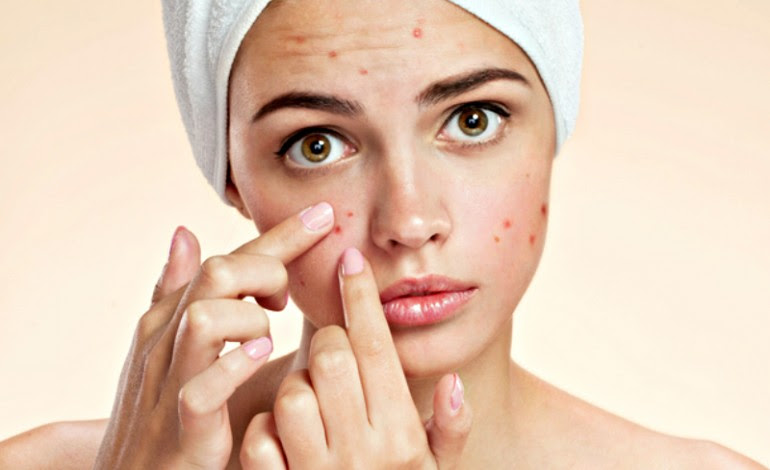 homemade recipes to get rid of acne