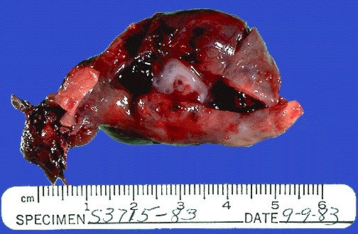 About half of ectopic pregnancies occur because of an identifiable lesion 