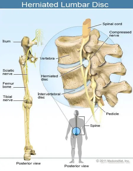 Sciatica Causes, Symptoms, Treatment - Sciatica Causes 
