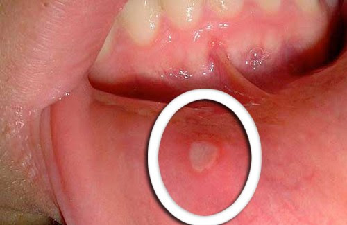 Guide sant : Maladies de la bouche : aphte, herpes