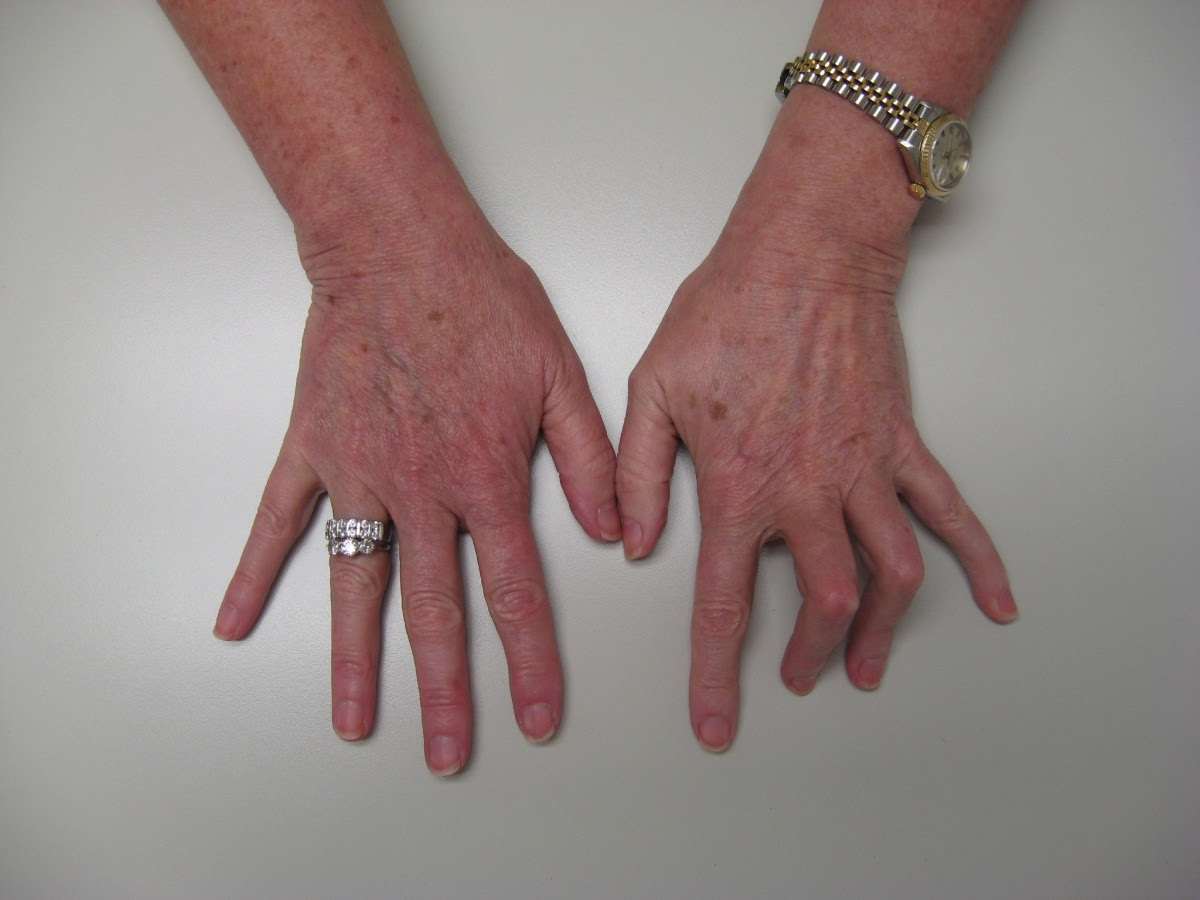 Transformation: Proximal Interphalangeal Joint Flexion Contractures