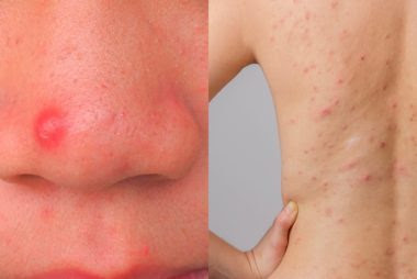 00-opener-What-The-Acne-On-Every-Part-Of-Your-Body-Is-Trying-To-Tell-You-shutterstock