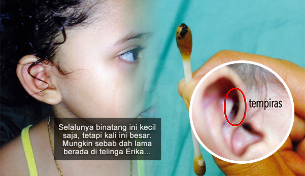 Ngeri! "Patutlah anak tak bagi saya sentuh telinganya" - Ibu jumpa tempiras bertelur dalam telinga anak