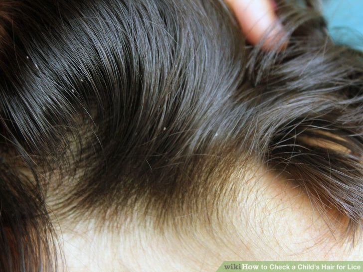 Check a Child's Hair for Lice Step 2.jpg