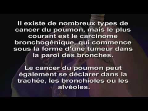 traitement most cancers ongle