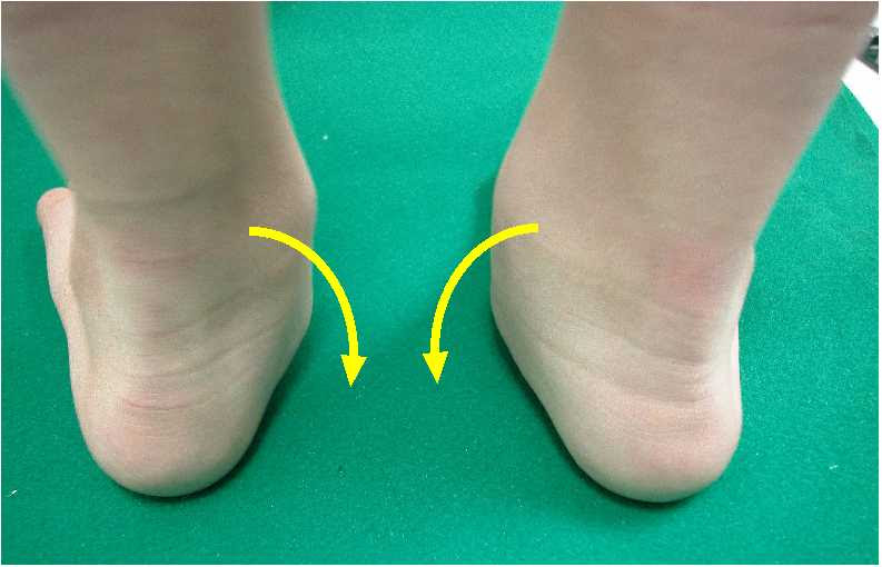 ダウン症の足に関する質問集