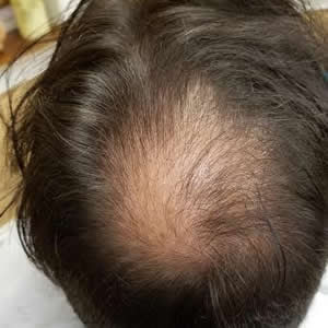 Ink Credible Scalp Micropigmentation