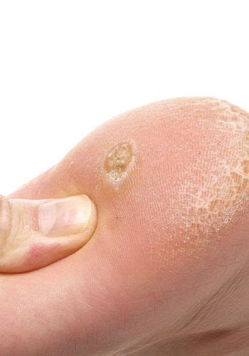 Although plantar warts are unpleasant, they are generally not a serious health threat. Corns And Calluses - Ottawa Foot Clinic