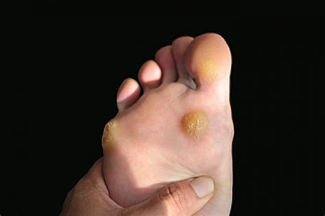 Subscribe to our free newsletters to receive latest health news and alerts to your email inbox. Common Signs Of Plantar Warts