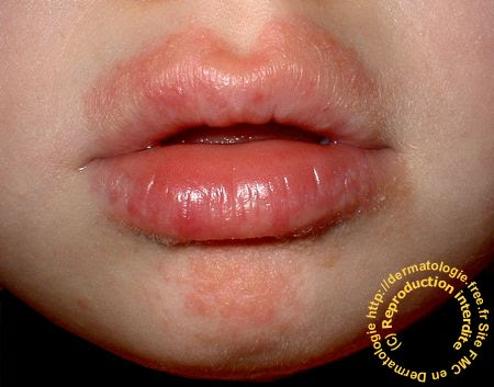 Dermatologie Cheilites Aigues Ou Chroniques Perleche Tetine Candidose Impetigo Tic De Lechage