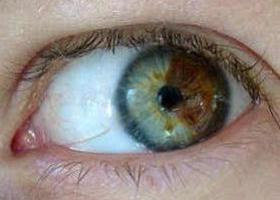 Oncology eyes  