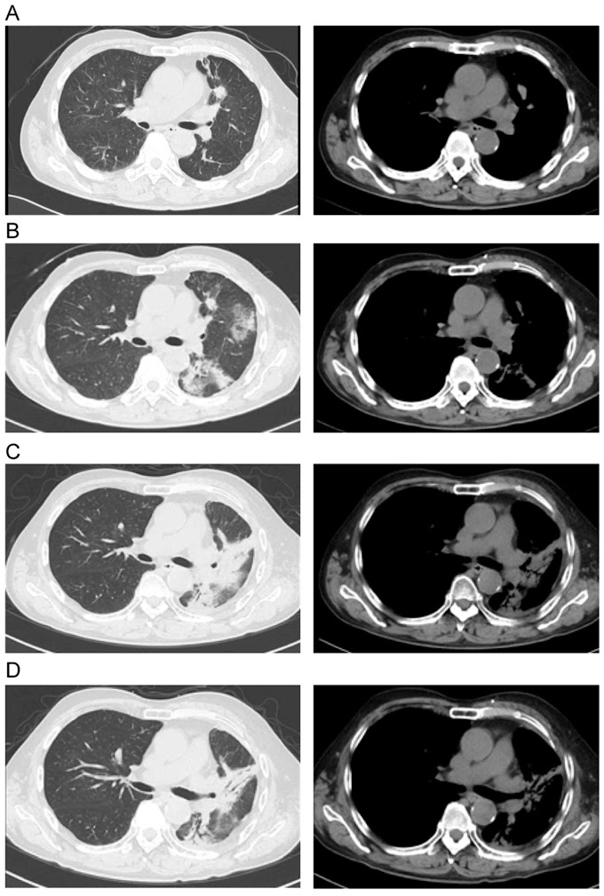 Mesothelioma Treatment Lung / Innovative Combined Treatment For Mesothelioma Prolongs Life - Lung cancer originates in the lungs, but it can spread.