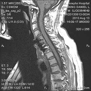 MRI Cervical Spine August 2013