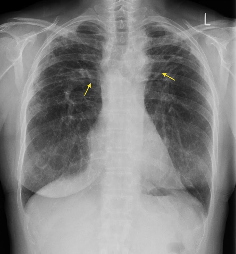 Sarcoidosis Radiology At St Vincent S University Hospital