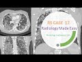 A patient with leptospirosis suddenly developed cough and dyspnoea | FRCR Radiology RS case 17