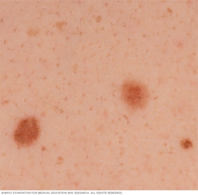 Warning Signs Of Melanoma Skin Cancer - What Is Melanoma Skin Cancer Sero : In stages three and four, the melanoma has spread beyond the skin and into the lymph nodes and/or distant organs, like the liver, lungs, brain, bone or soft tissues.
