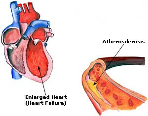 High Blood Pressure Picture