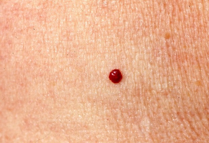 Skin Cancer Rates Over The Years / é¶åPD-1åPD-L1çè¿ç¤åç«è¯ç© - ç¥ä¹ - According to the american cancer society, just over 100,000 new cases of skin cancer are diagnosed in the united states each year.