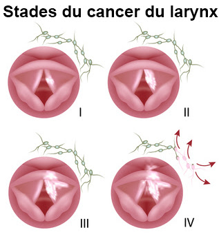 traitement du most cancers de sein