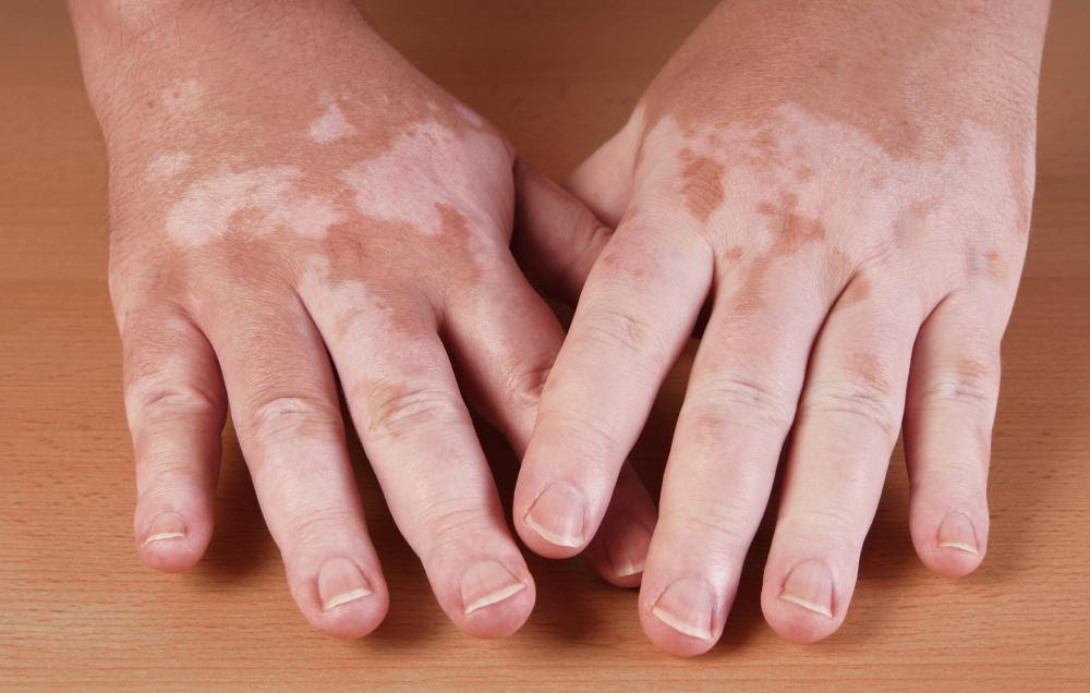 نتيجة بحث الصور عن ‪Top benefits of beta-carotene on the skin.‬‏