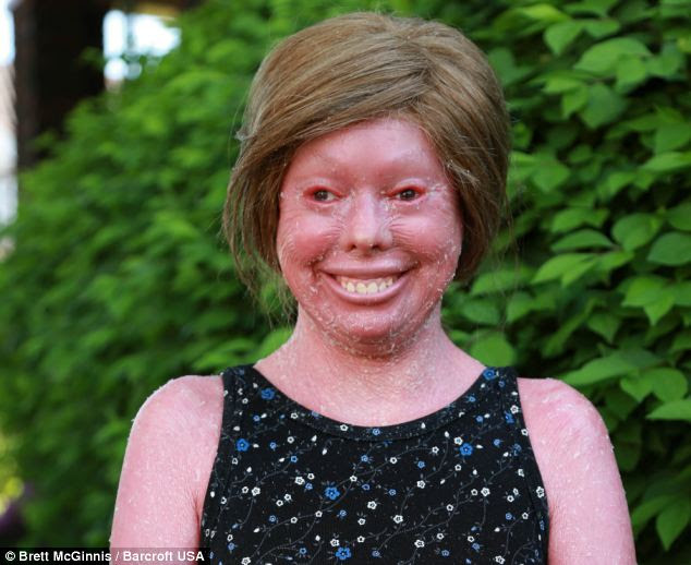 Skin condition ichthyosis uk