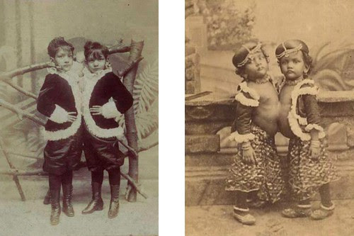 Radica and Doodica Siamese Twins