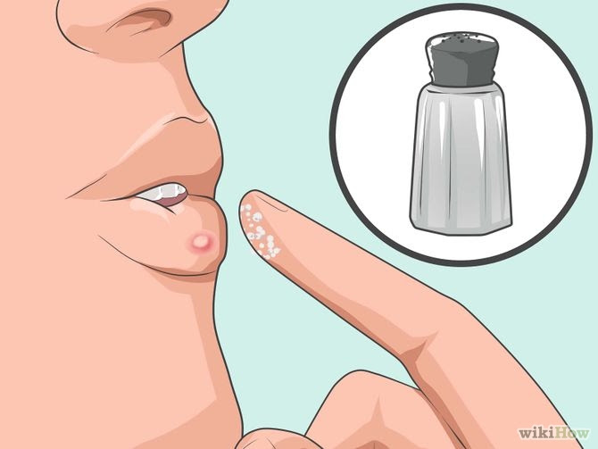 Heal a Cold Sore Naturally Step 9 Version 2.jpg