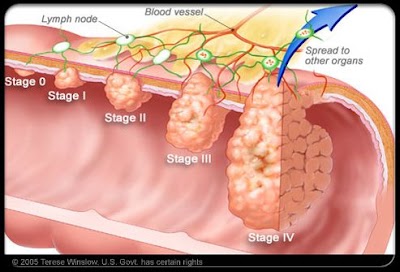 What Is Stage 4 Cancer In The Stomach