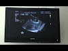 Pregnant With Twins 8 Weeks
